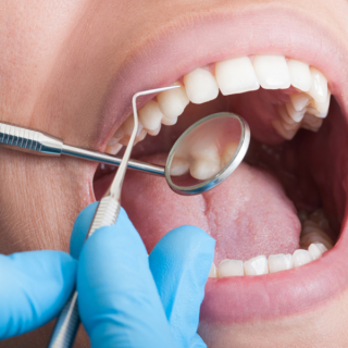 alternative la implanturile dentare