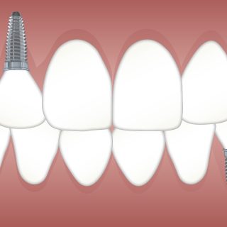 implanturi dentare