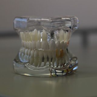 implanturi dentare